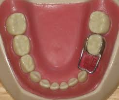 Easy way to get beautiful dental crowns and teeth crowns before and after
