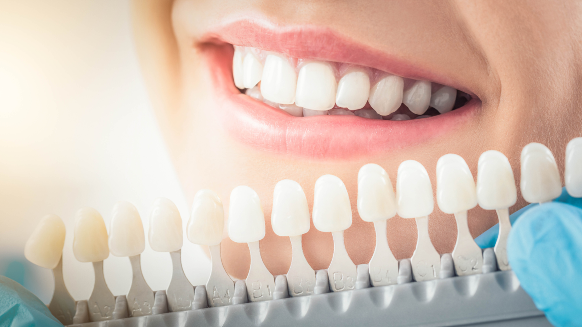 Composite veneers: What You All Need To Know