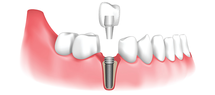 How to Choose the Right Dental Implant Specialist