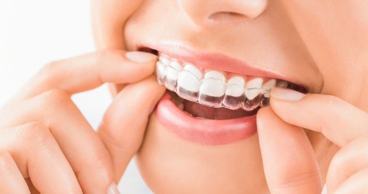 Invisalign: A Discreet Solution for Teeth Alignment