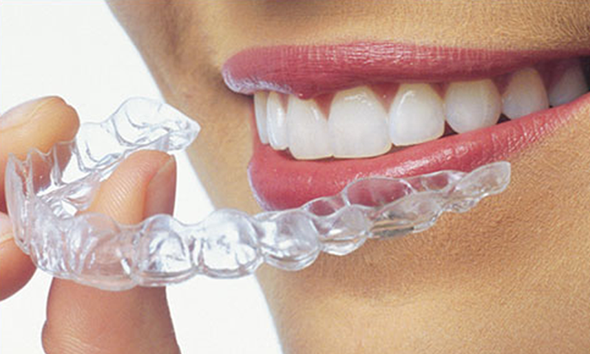 5 Reasons to Choose Clear Aligners Over Braces