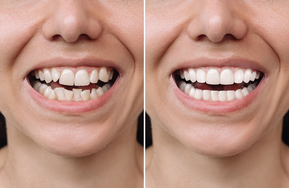 Dental Veneers: A Solution for Imperfect Teeth