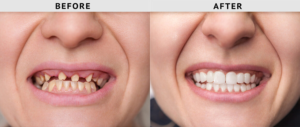How to Choose the Right Missing Teeth Repair Option