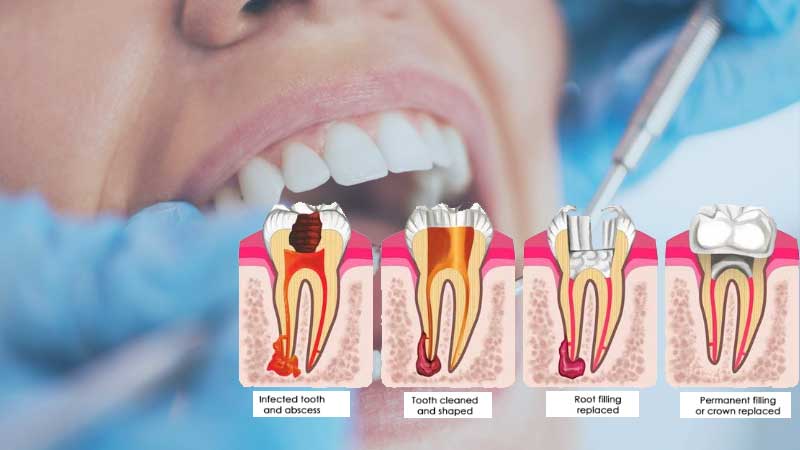 The 5 Stages of Root Canal Therapy Explained