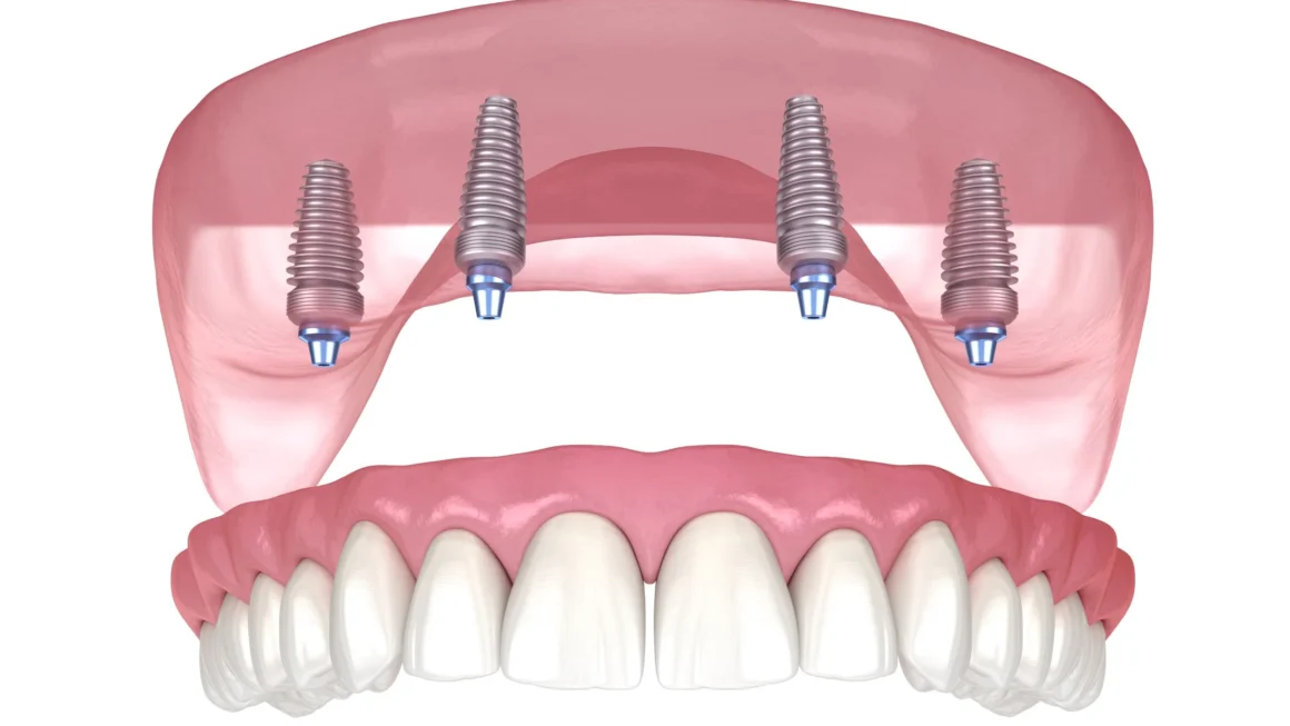 All-on-4 Dental Implants