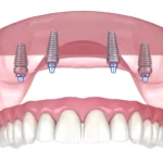 All-on-4 Dental Implants