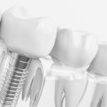Dental Implants in Winslow