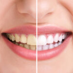 teeth whitening